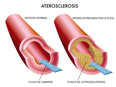aterosclerosis-que-la-provoca-y-como-prevenirla
